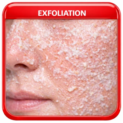 Exfoliation